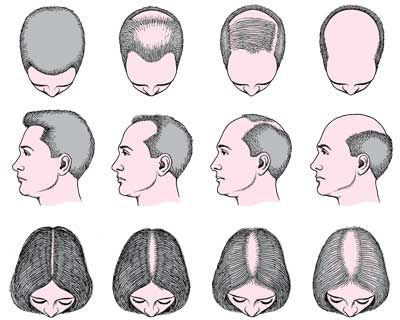 Tipo de alopecia en el hombre y la mujer